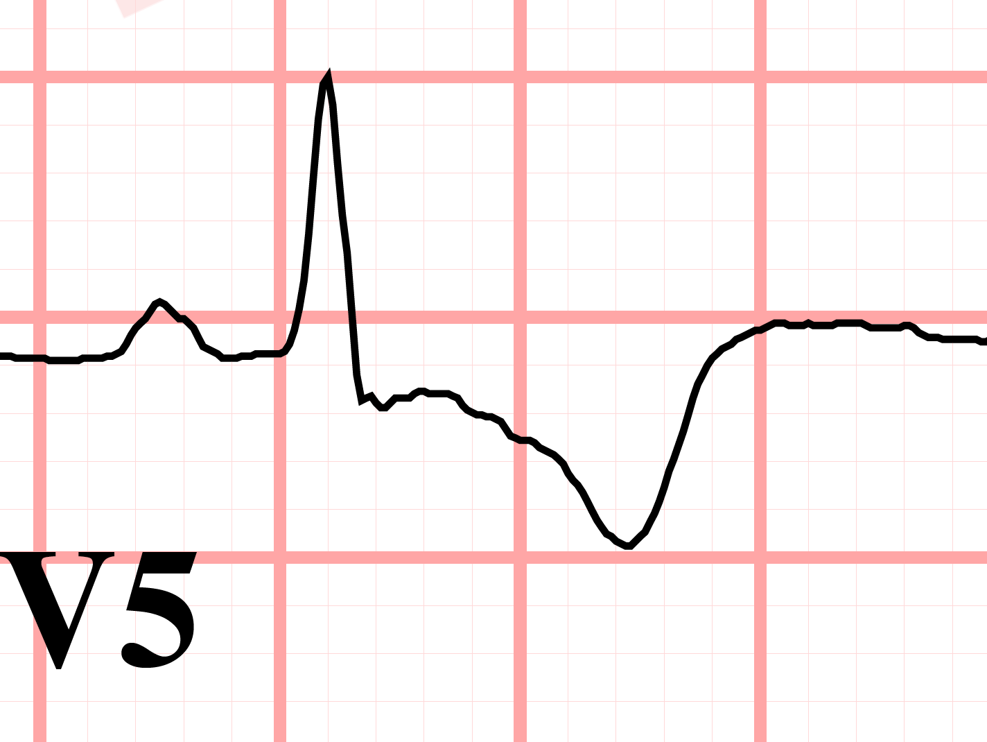 inverted-t-wave